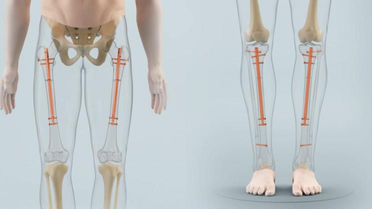 Thời gian điều trị và hồi phục sau phẫu thuật kéo dài chân ở Mỹ là bao lâu?
