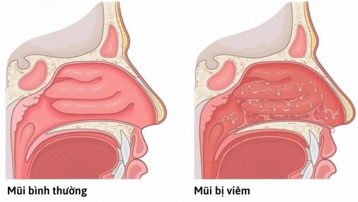 7. Cách Phòng Ngừa Viêm Mũi